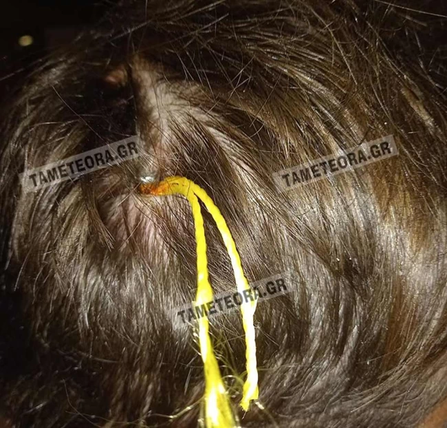 Απίστευτο: Καρφί 5 εκατοστών σφηνώθηκε στο κεφάλι άνδρα στην Καλαμπάκα [εικόνες]