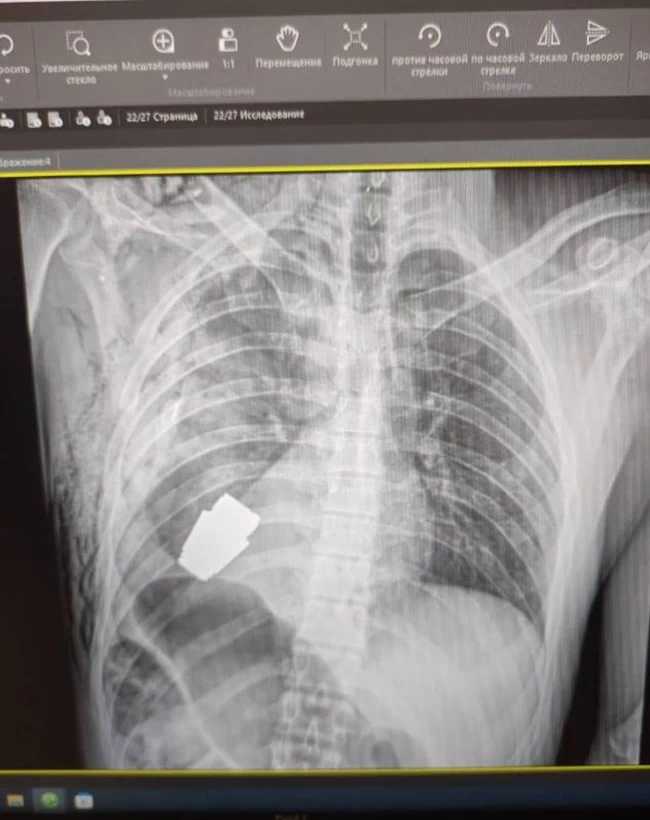 ΟΥΚΡΑΝΙΑ ΧΕΙΡΟΒΟΜΒΙΔΑ