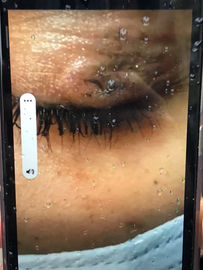 Δραπετσώνα: Ανήλικη έσβησε τσιγάρο στο μάτι της 16χρονης συμμαθήτριάς της - Σοκάρει η εικόνα