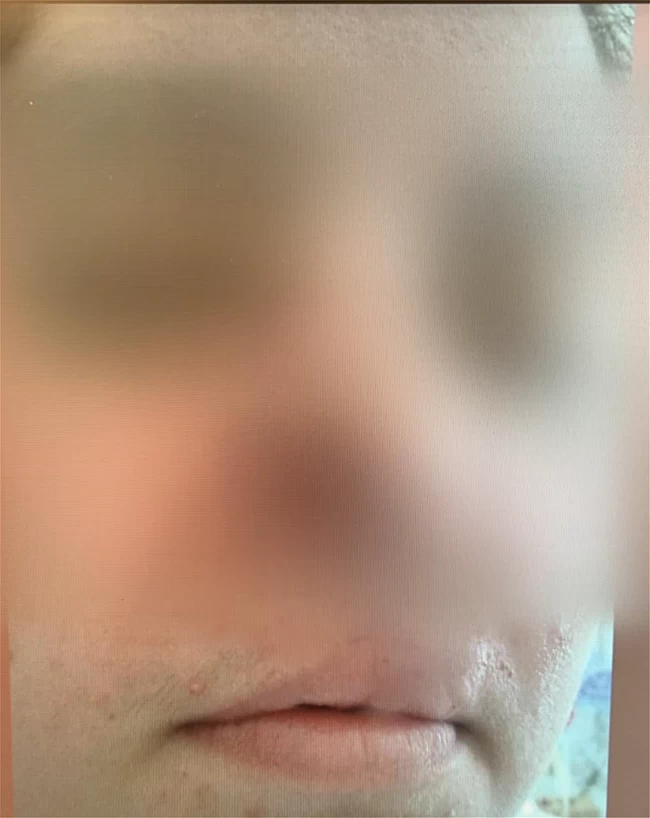 Σοκ από την επίθεση που δέχτηκε 35χρονη από πιτ μπουλ που υιοθέτησε: Της έκοψε τη μύτη - "Νόμιζα ότι θα πεθάνω"