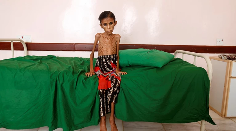 Εικόνες γροθιά στο στομάχι: Ετσι πεθαίνουν τα παιδιά της Υεμένης...